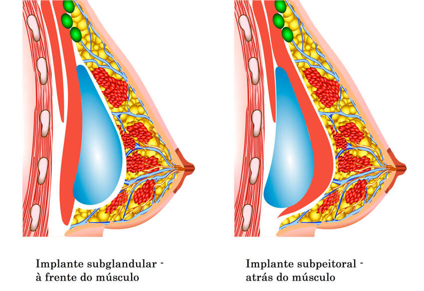 esquema desenhado da mama após colocação do implante; na imagem da esquerda vemos a posição subglandular à frente do músculo; na imagem da direita a posição subpeitoral atrás do músculo