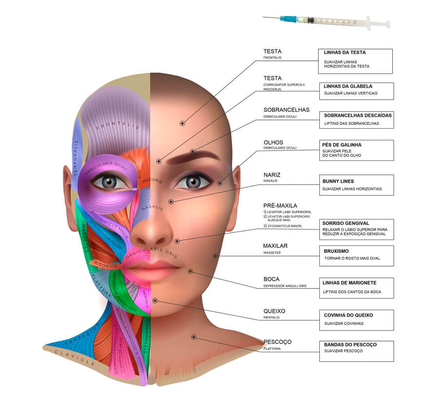 Esquema desenhado de um rosto, em que à esquerda são demonstrados os vários músculos da mímica facial com diferentes cores e na metade direita são apontadas as principais áreas da face que podem ser tratadas com botox