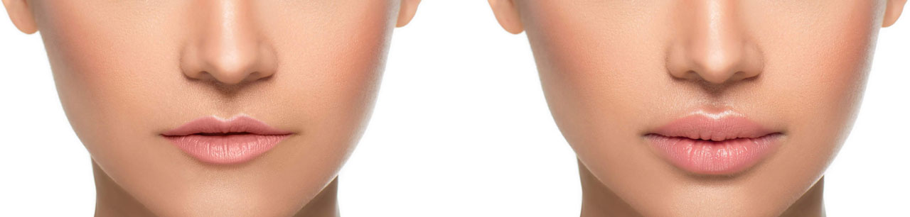 Duas imagens frontais do rosto de uma mulher jovem, sob um fundo branco; à esquerda antes do aumento de lábios e à direita após o tratamento, podendo verificar-se uns lábios mais definidos e carnudos