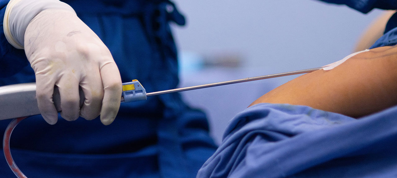 imagem de bloco operatório de uma lipoaspiração realizada atravès de uma pequena incisão, com o cirurgião segurando na cânula com a sua mão direita