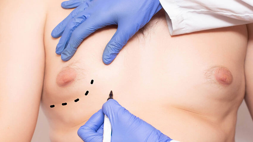 imagem frontal do peito de um homem com ginecomastia, mostrando as mãos, com luvas azuis, do cirurgião a fazer as marcações para uma lipoaspiração