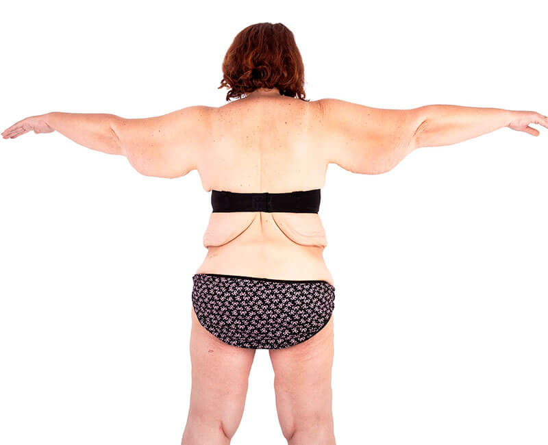 vista posterior de uma mulher após perda massiva de peso, sob um fundo branco, e demonstrando o excesso de pele flácida nos braços, costas e face interna das coxas
