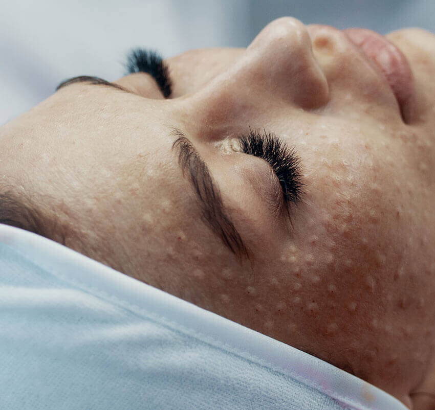 Imagem oblíqua do rosto de uma mulher deitada, que apresenta várias pápulas na hemiface direita decorrentes de uma biorevitalização com mesoterapia