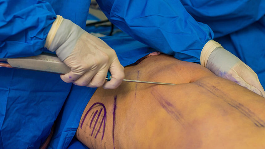imagem de bloco operatório com uma barriga a ser lipoaspirada através de um pequeno orifício no umbigo, com o cirurgião segurando na cânula com a sua mão direita
