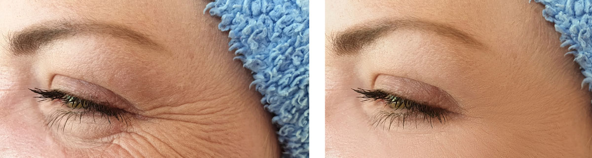 Duas imagens oblíquas esquerdas da região em torno do olho de uma paciente antes e após fazer botox; à esquerda mostra o olho com os pés-de-galinha pronunciados; à direita, após o tratamento com botox, sem estas rugas de expressão