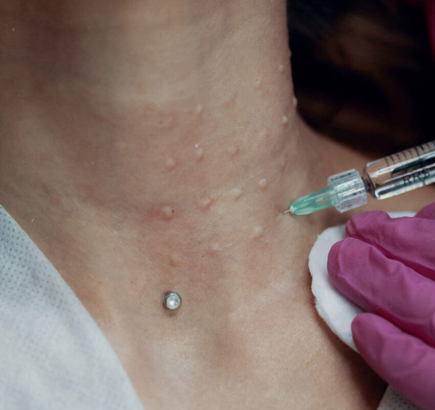 Imagem frontal de o pescoço de uma mulher, sobre um fundo escuro, a ser submetida a um tratamento de mesoterapia nas linhas cervicais