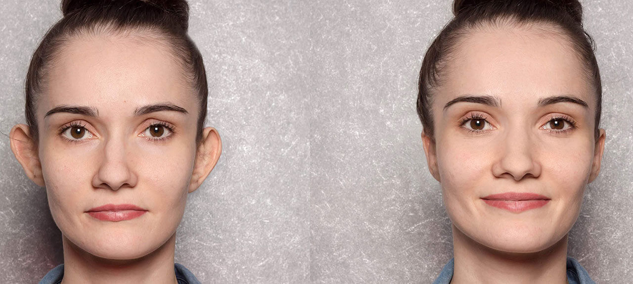 Duas imagens com vista frontal de uma mulher com orelhas de abano, sob um fundo cinzento; à esquerda o pré-operatório e à direita as orelhas bem encostadas à cabeça após a otoplastia
