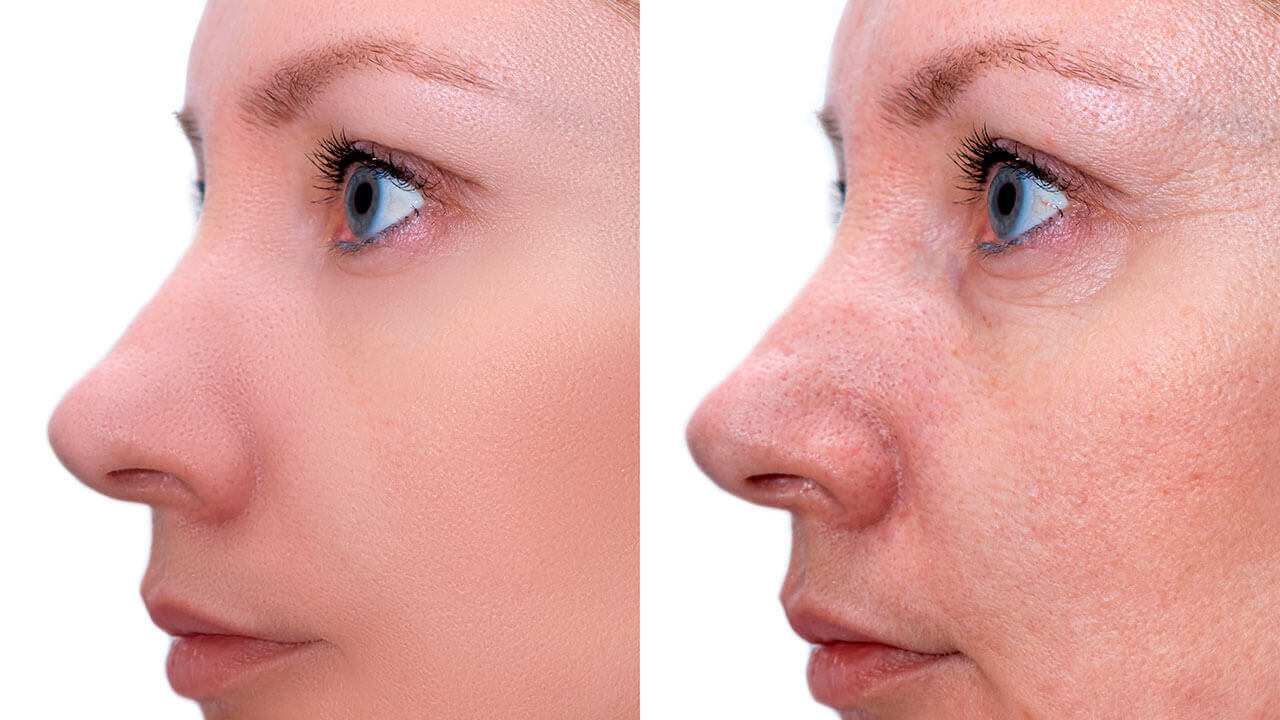 Duas imagens em perfil do rosto de uma mulher, antes (à direita) e após mesoterapia (à esquerda); é possível verificar uma melhoria do brilho, pigmentação e textura da pele, assim como uma diminuição das rugas finas, após o tratamento