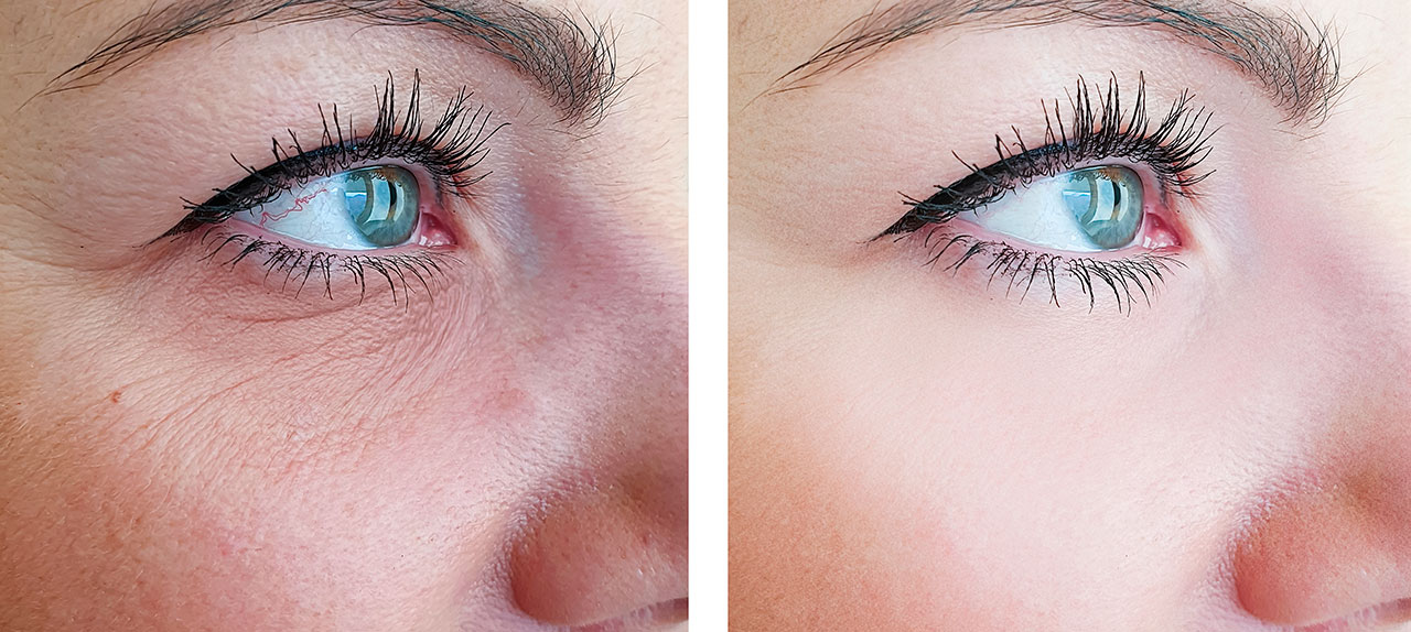 Duas imagens oblíquas da hemiface direita de uma mulher, antes (à esquerda) e após (à direita) tratamentos com peeling; é possível verificar a melhoria da textura e brilho da pele, tal como, uma redução das rugas finas