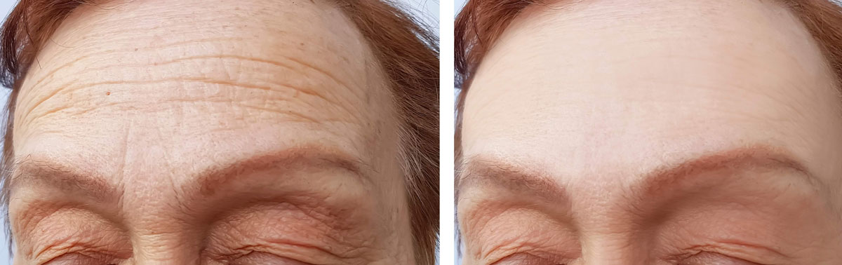Duas imagens frontais da região superior do rosto de uma paciente antes e após fazer botox; à esquerda antes do tratamento e à direita após, com uma clara diminuição das rugas da testa e glabela