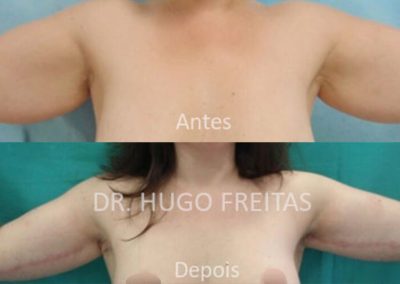 Cirurgia dos Braços (Braquiplastia)