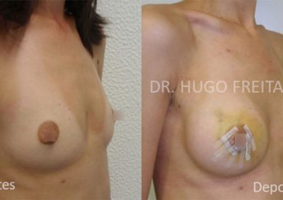 Mamoplastia de Aumento (Implantes de Silicone)