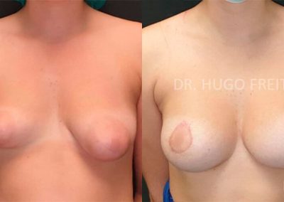 Mamoplastia para Correção de Malformações (mama tuberosa)