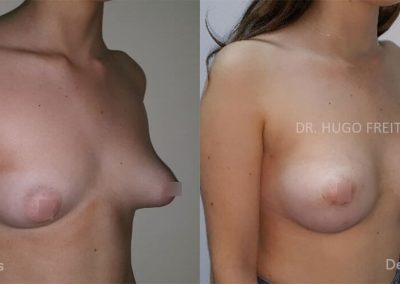 Mamoplastia para Correção de Malformações (mama tuberosa)