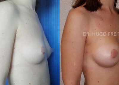 Mamoplastia de Aumento (Implantes de Silicone)