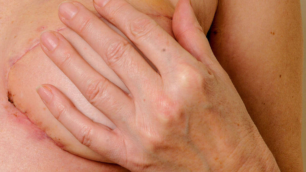 imagem frontal e ampliada da mama esquerda, após mastectomia e reconstrução diferida com tecidos autólogos abdominais; mão esquerda cobre o mamilo